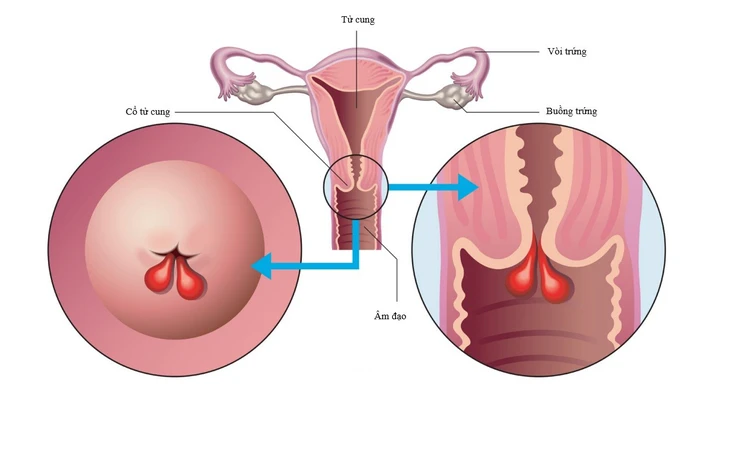 Polyp cổ tử cung có cần phẫu thuật không?