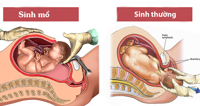 Sinh thường và sinh mổ: Nên lựa chọn thế nào?