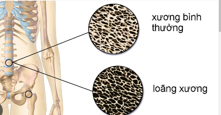 Những thực phẩm giúp phòng ngừa loãng xương