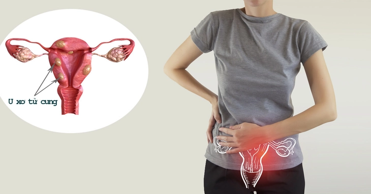 U xơ tử cung có ảnh hưởng đến khả năng mang thai?